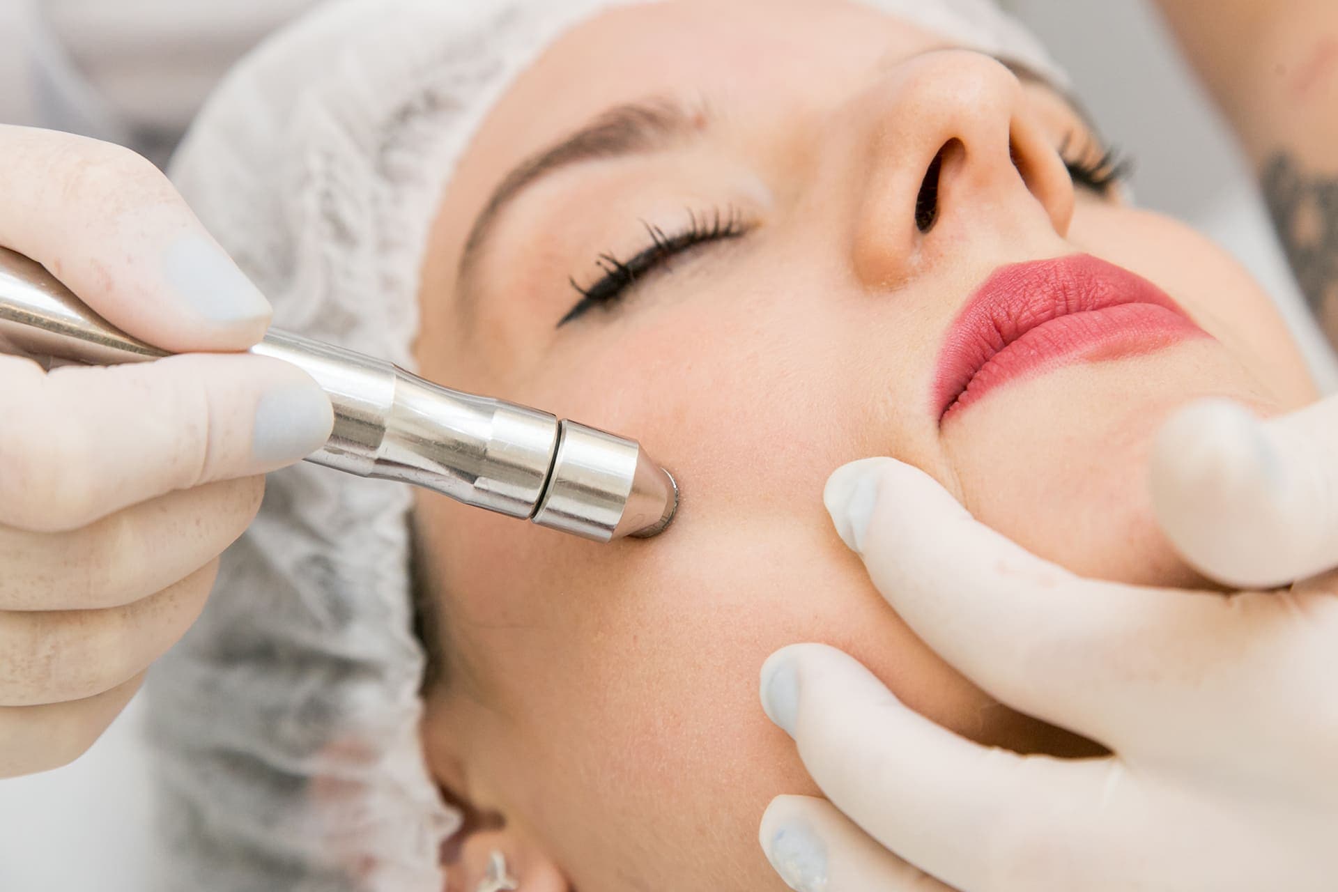 Peeling de Diamante 1