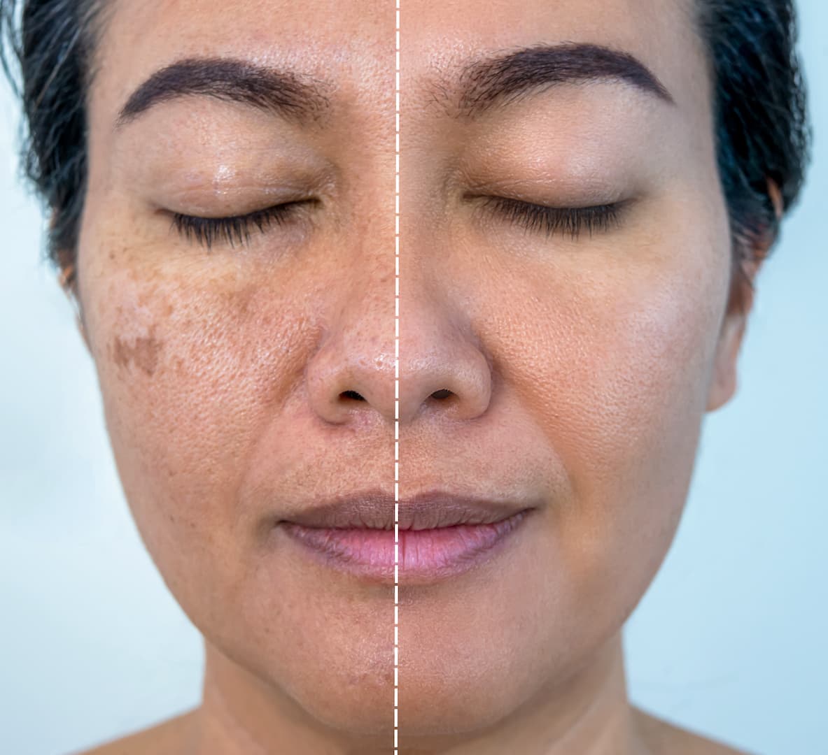 Tratamento de Melasma 2