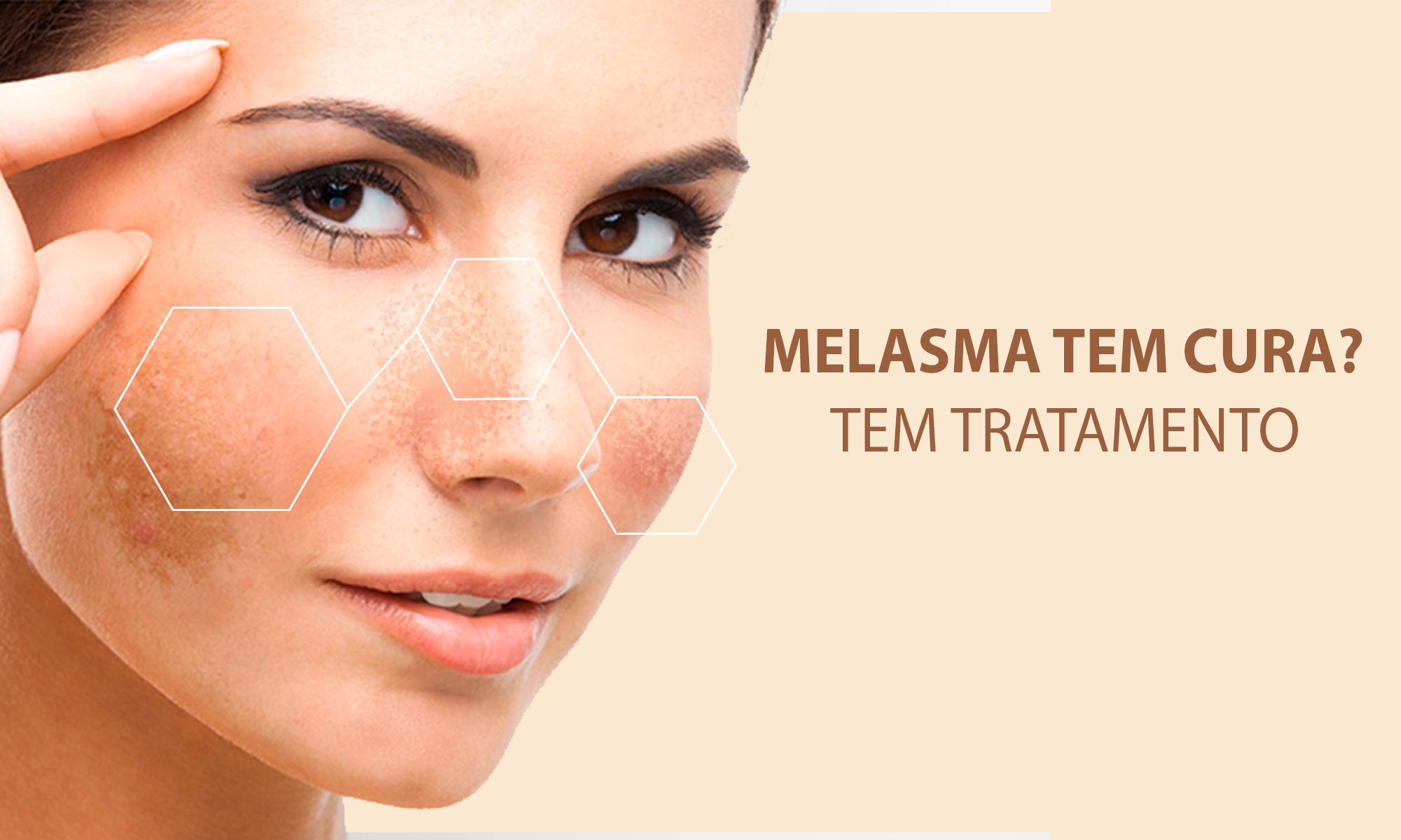 Tratamento de Melasma
